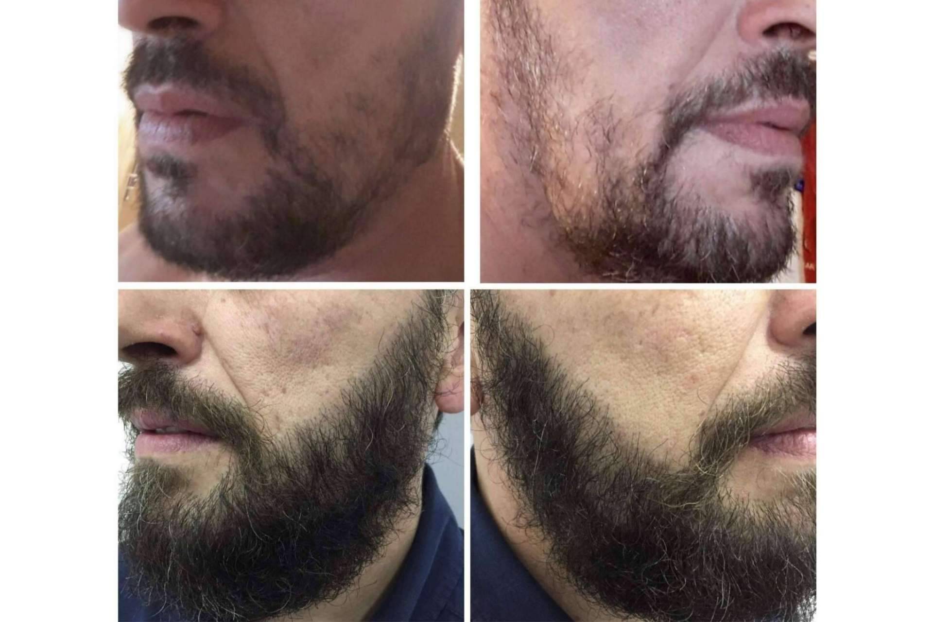 Pasos a seguir en un injerto de barba, por el Dr. Bruno Jacobovski